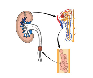 I calcoli renali si formano nella cavità del rene